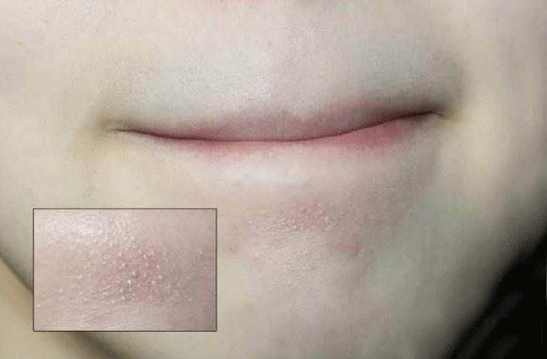 十个女生有九个都存在的问题:长在下巴的白色小颗粒是什么?