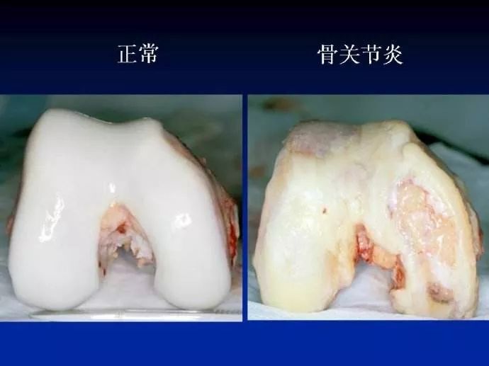 八成老年人膝关节软骨磨得剩一半!做好"4个一",延缓关节衰老