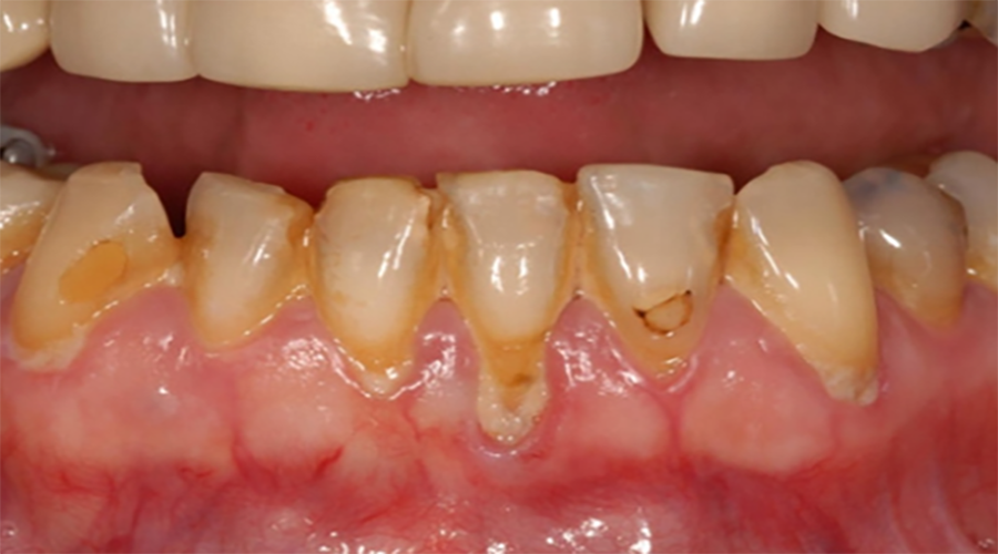 看看牙菌斑是如何一步步让你黄掉牙!