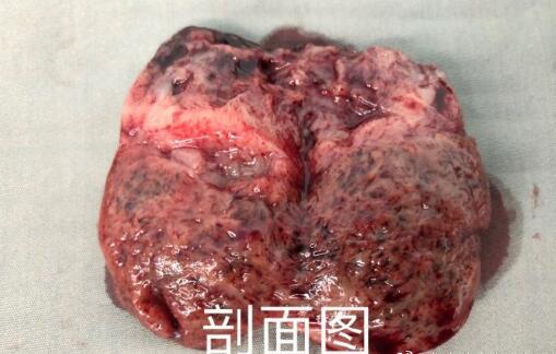 患者年轻女性体检发现右下腹肿物警惕小肠间质瘤可能