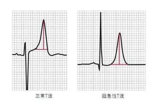 但如果t波有明顯的增高,那可能是心肌梗死早期或高鉀血癥