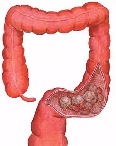 肠癌腹部包块位置图片图片