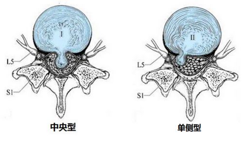 针灸治疗腰椎间盘突出症