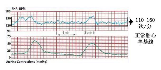 胎儿心动过速胎心基线