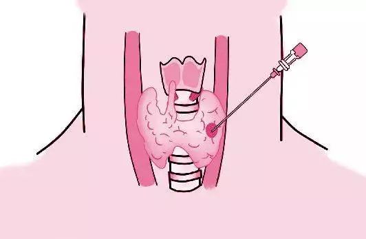 甲状腺穿刺不行?结果不准?还可能引起肿瘤转移?__凤凰网
