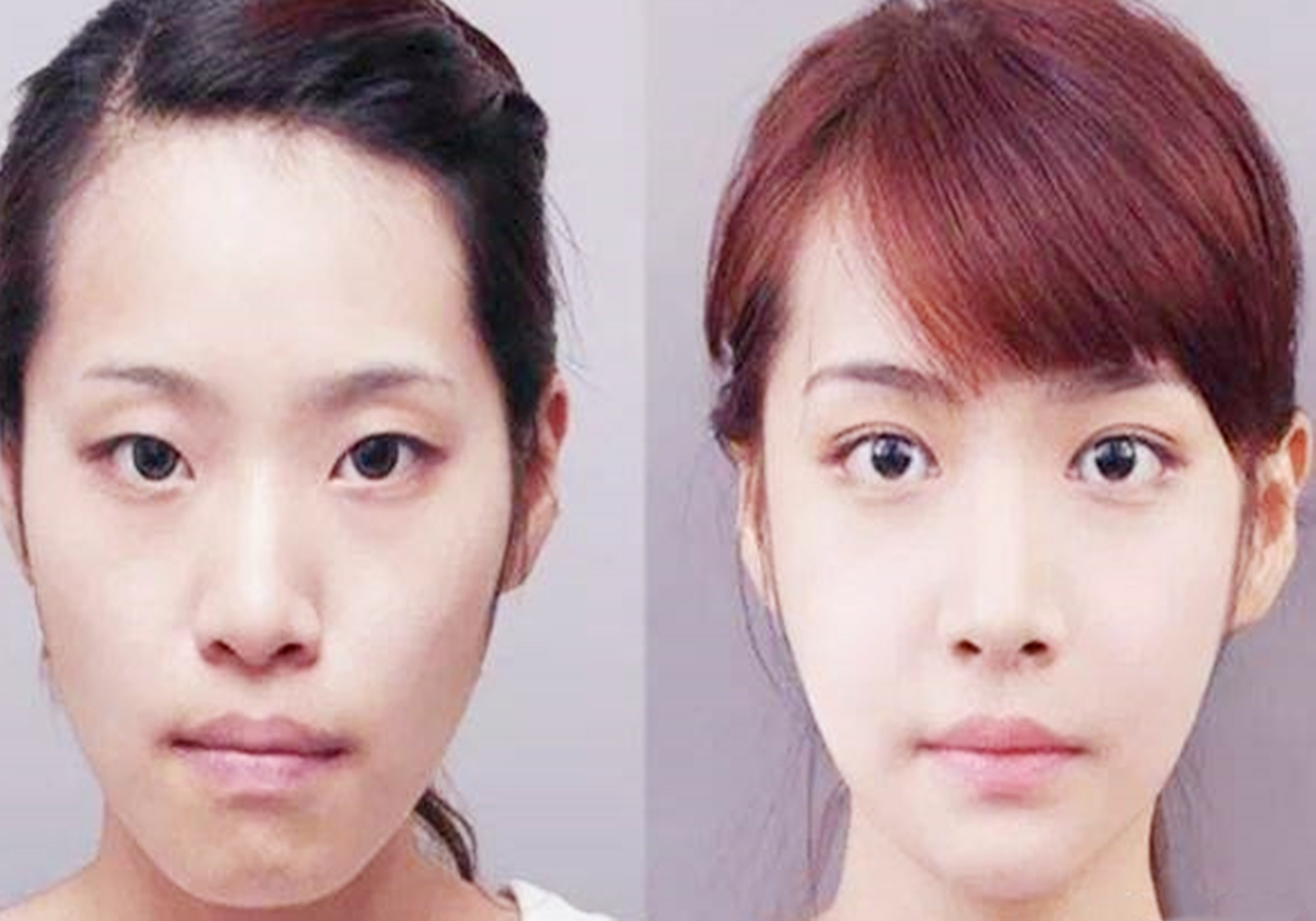 开学前夕儿童整容风潮叠起,原因惹人唏嘘