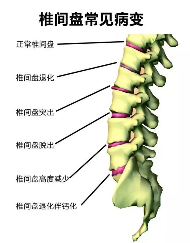 腰椎结构图立体图片