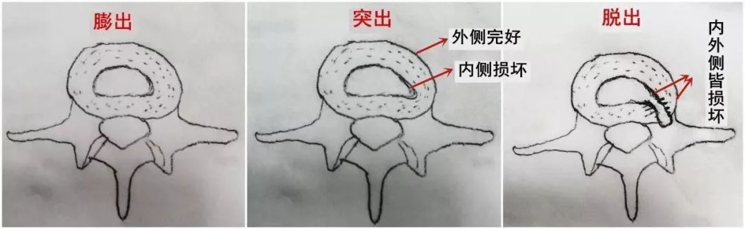 如果你还年轻,请照顾好你的椎间盘