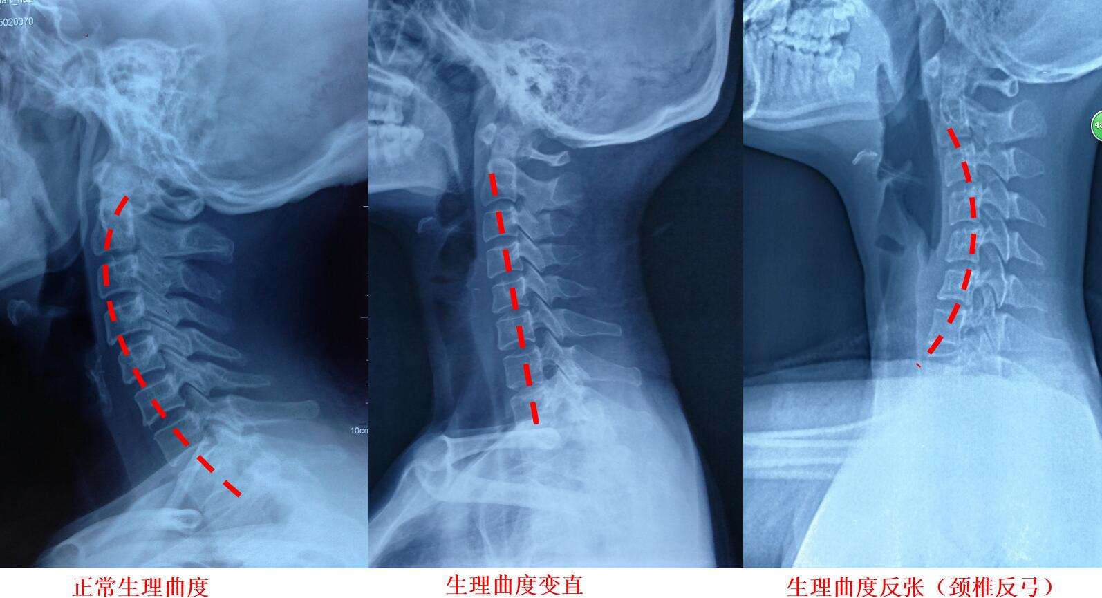 通俗来说就是颈椎的正常生理曲度消失