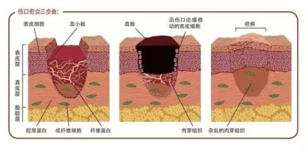 什麼是瘢痕