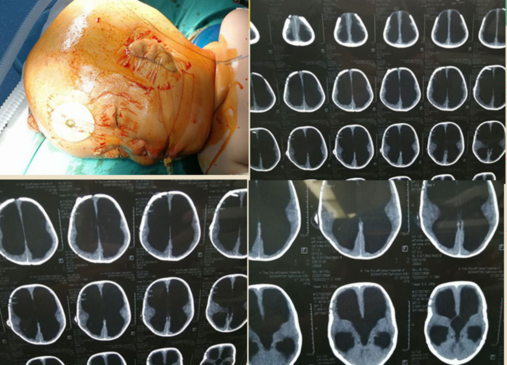 婴儿重度脑积水应尽早治疗,不要盲目相信偏方