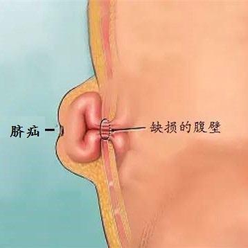 孩子腹白线疝气图片图片