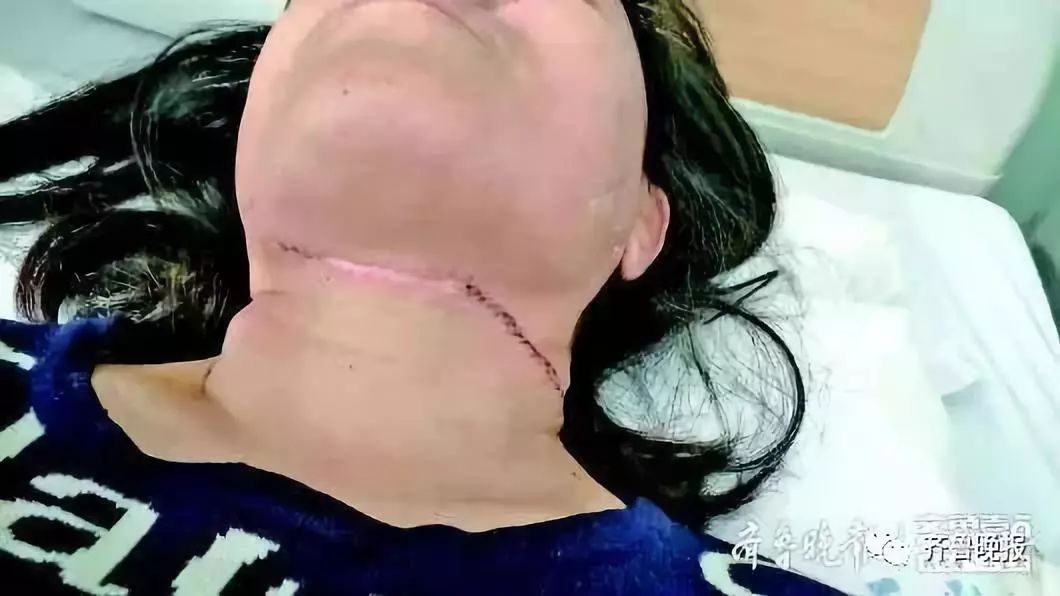 泰安女子遭风筝线割喉风筝线有多大杀伤力