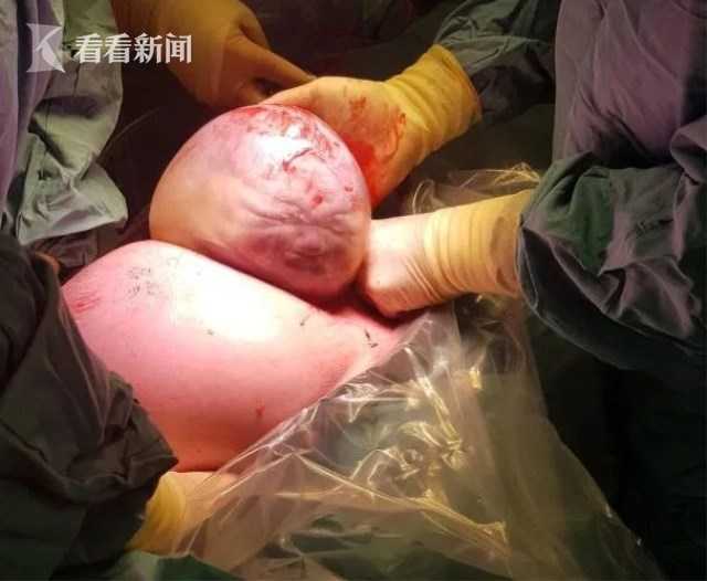 羊水未破就被剖腹产男婴包膜出生活像外星人