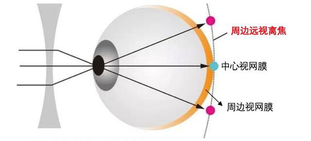 儿童近视控制之——周边离焦__凤凰网