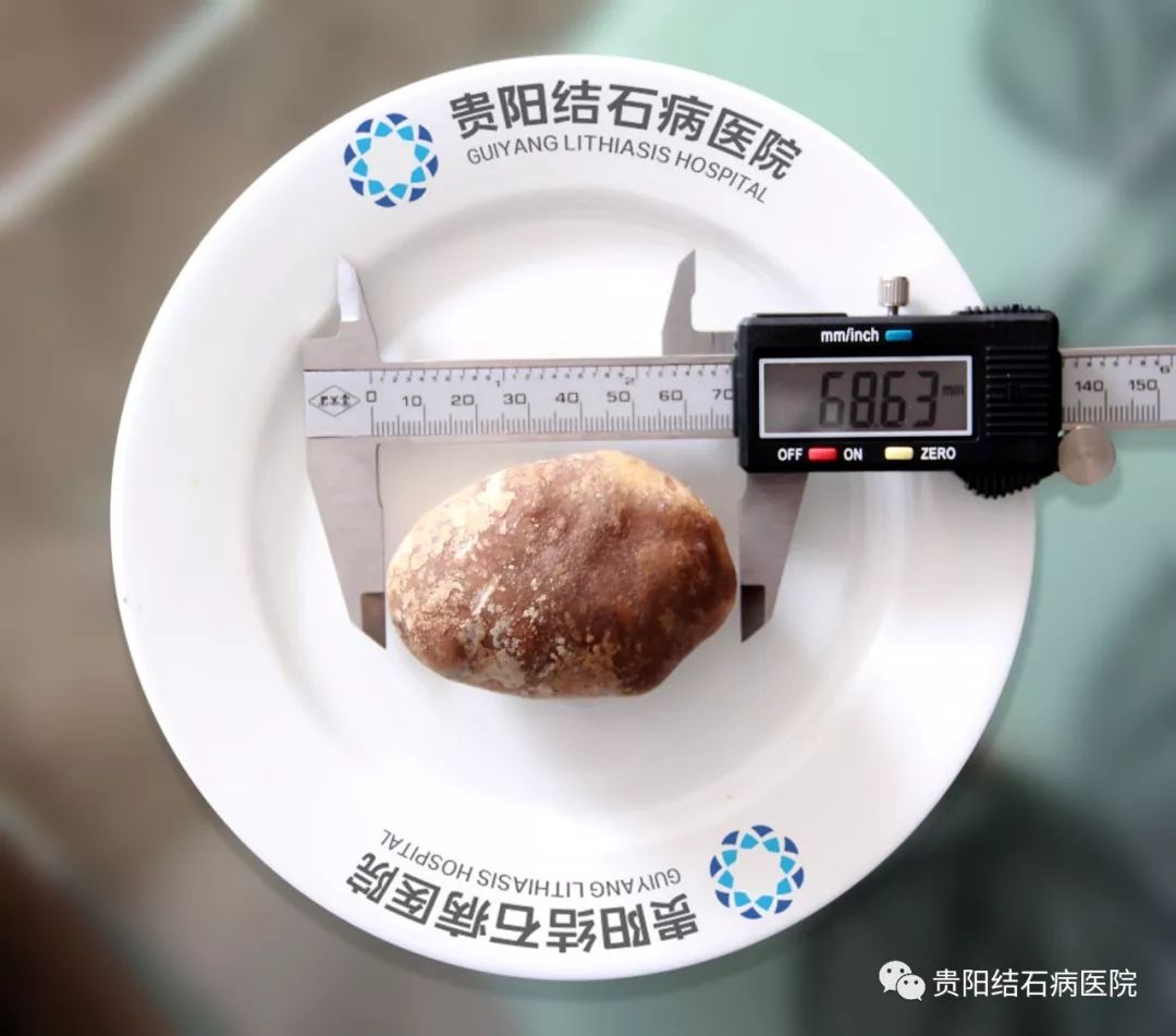6.8公分!这么大的结石,长在肾脏里是什么感觉?__凤凰网