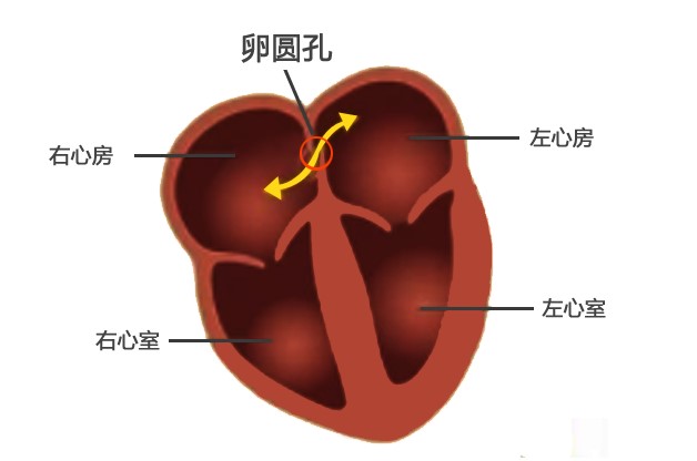 打开凤凰新闻,查看更多高清图片先来说说动脉导管未闭和卵圆孔未闭