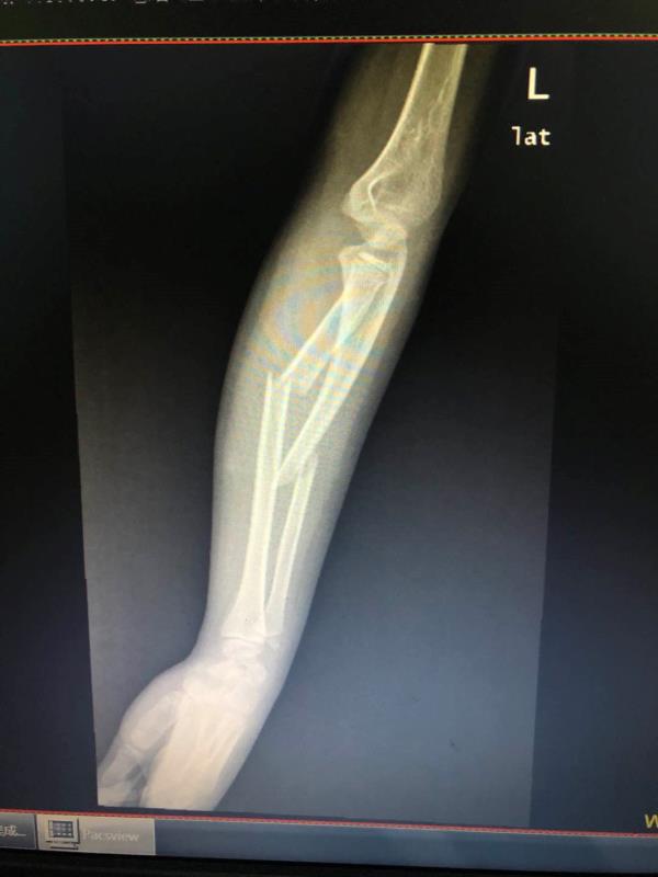 深圳8岁男童玩蹦床手臂骨折儿童娱乐设施安全隐患你了解吗