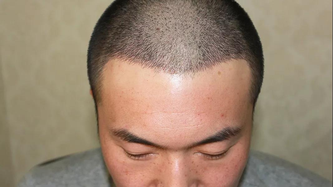 现在植发都是怎么收费的毛囊移植价位怎么算