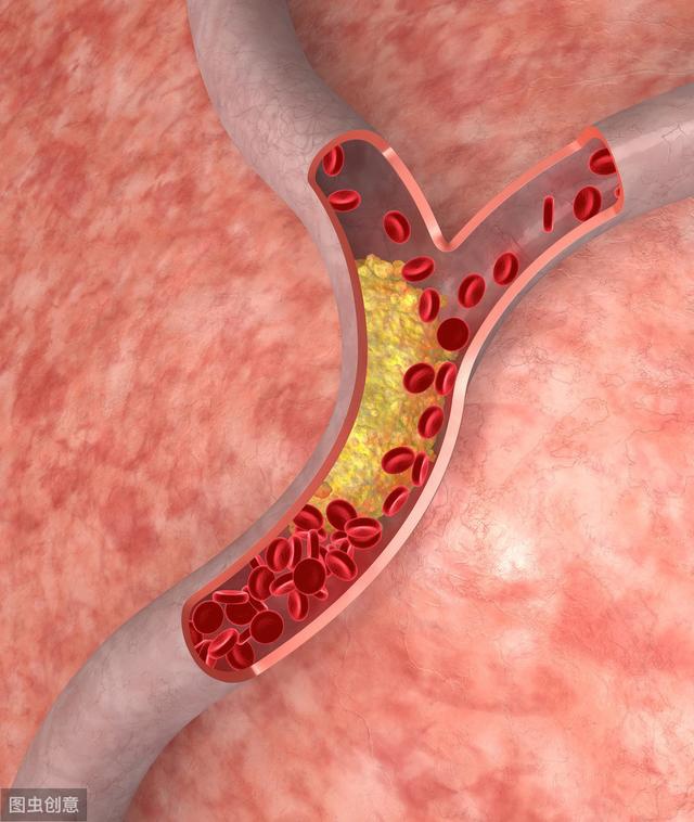 动脉硬化斑块了,身体发出4个信号,一个不占,说明血管还算健康__凤凰网