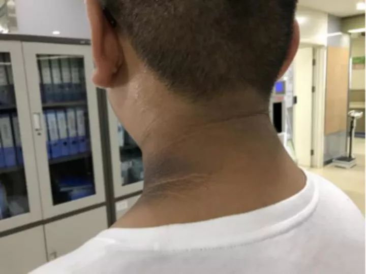 哈尔滨杭州两个10岁男孩得了同样的病白白胖胖的他们突然变黑了