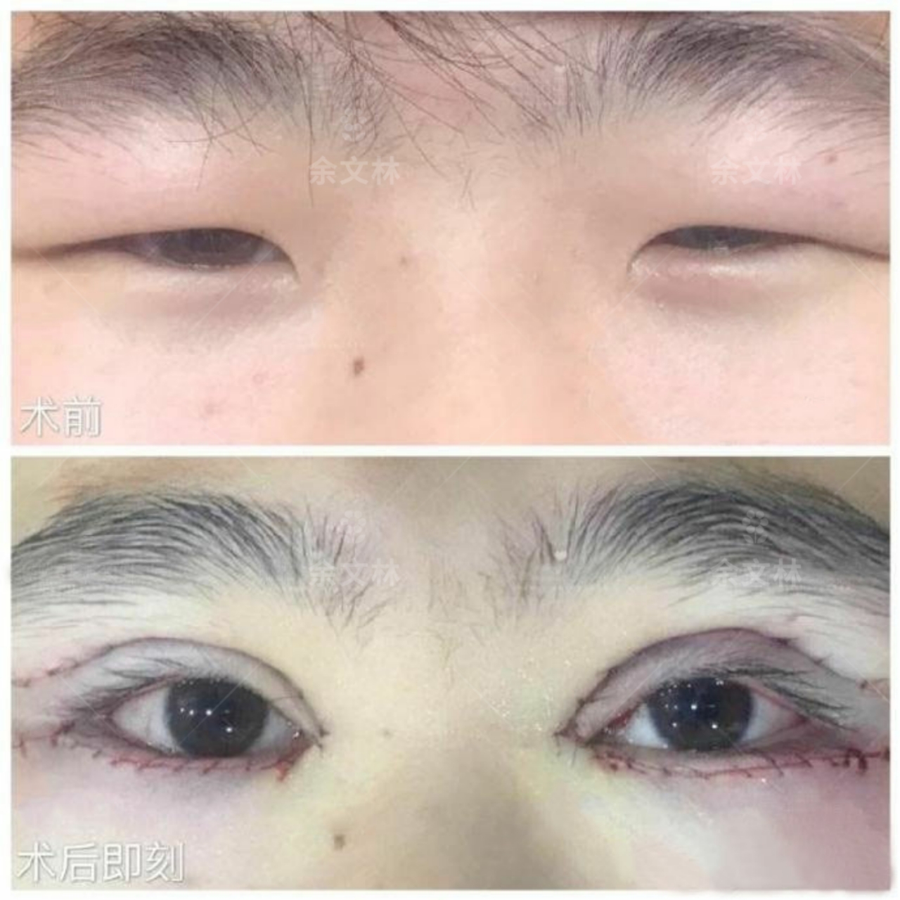 浅谈先天性小睑裂综合征治疗