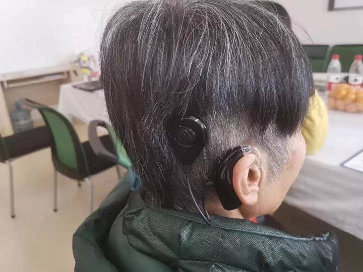 山东56岁女子患线粒体脑肌病致失聪省立医院为其植入人工耳蜗