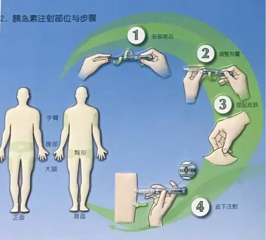 2.按照藥理特性分類 二,胰島素的注射部位及步驟