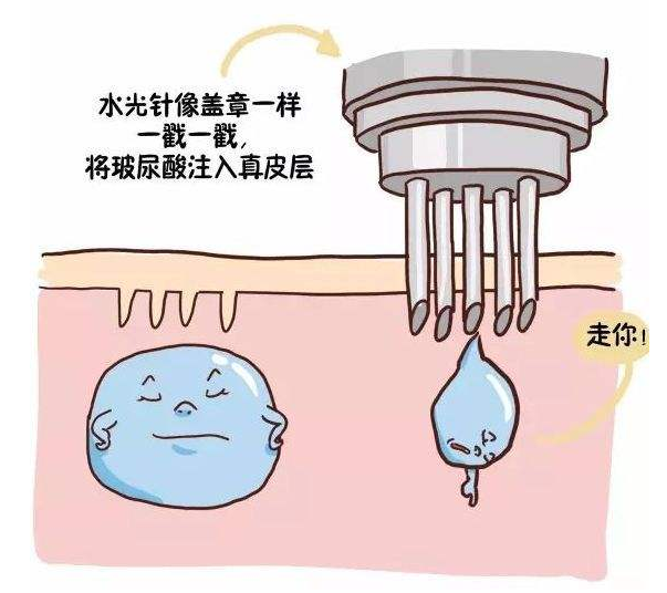 ⑤廣泛適用:透明質酸適用於任何有需要治療的年齡層,任何年齡注射