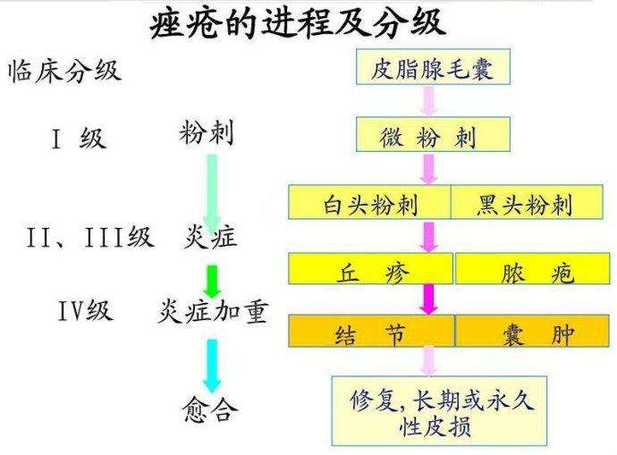 痤疮产生的三个关键性因素,一是内分泌紊乱,导致皮脂腺分泌油脂过多