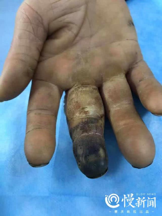 手指被竹签戳伤用土法治疗竟导致截指糖尿病手要特别注意这六点