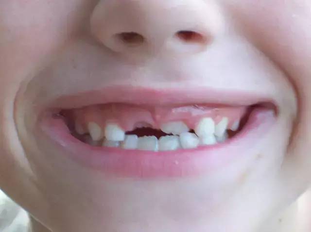牙齿长在牙龈外面图片图片