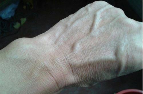 头部有青筋怎么办哪一类青筋属于正常哪一类需要预防中风