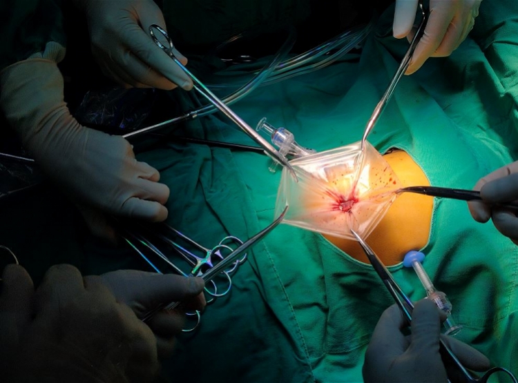 1岁宝宝腹腔内装上"红绿灯",指引医生精准切除巨大肝母细胞瘤