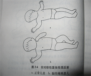 4,非对称性紧张性颈反射:用两手持小儿侧头部左右回旋头,如为脑瘫患儿