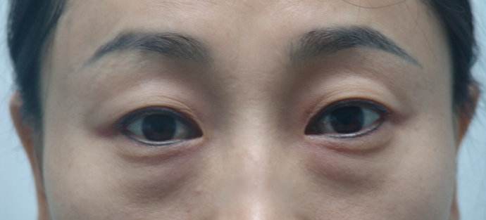 先天性眼袋最早几岁可以做去眼袋手术?