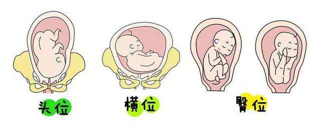 如果胎儿是 横位,并且没能及时纠正过来,容易导致脐带脱垂和子宫破裂