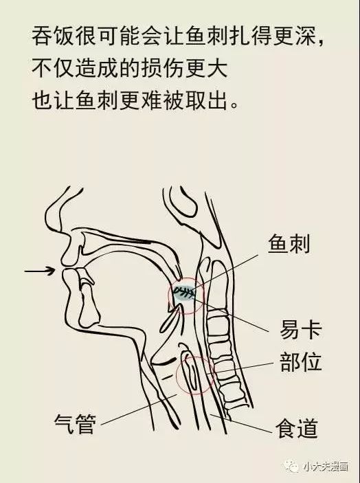 萧山一老人误吞鱼刺5天才去医院,食管穿孔,一个多月不能经口吃东西__凤凰网