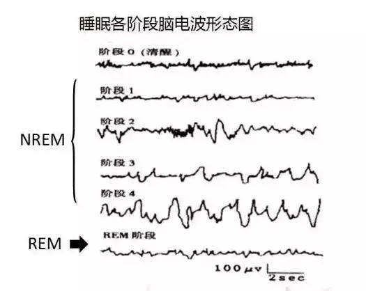 什么是「睡眠瘫痪症」?