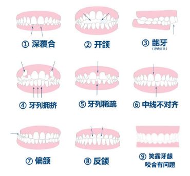 兒童牙齒矯正的那些事情,你知道多少?