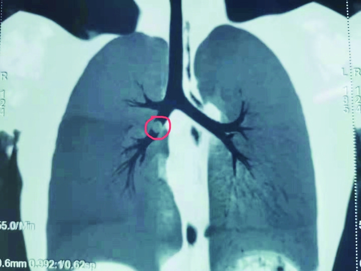哈医大一院呼吸科专家利用支气管镜成功将异物取出.
