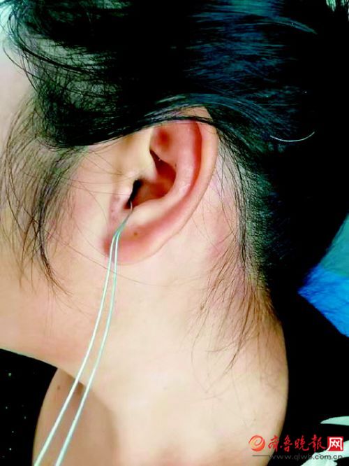 长长的铁丝卡在女子耳朵里.