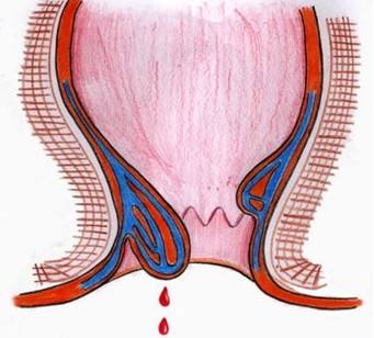 穿的不选对痔疮会让你遭罪