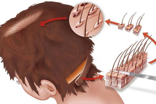 fut毛髮種植技術為什麼會被淘汰?