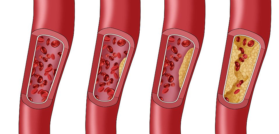 血脂堵,手脚先知,喝好三杯水,常动四处,可疏通血管,防血栓__凤凰网