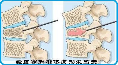 意大利脊柱骨水泥图片