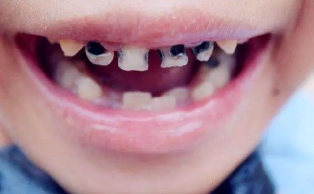 4岁男童拔光20颗乳牙,医生说不是糖,是父母的问题