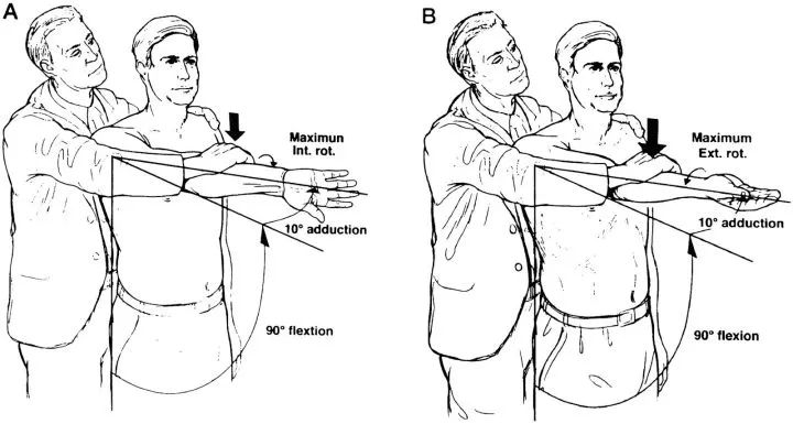 肩关节上盂唇撕脱损伤slap损伤
