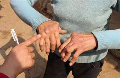 类风湿性关节炎患者什么时候可以停药?