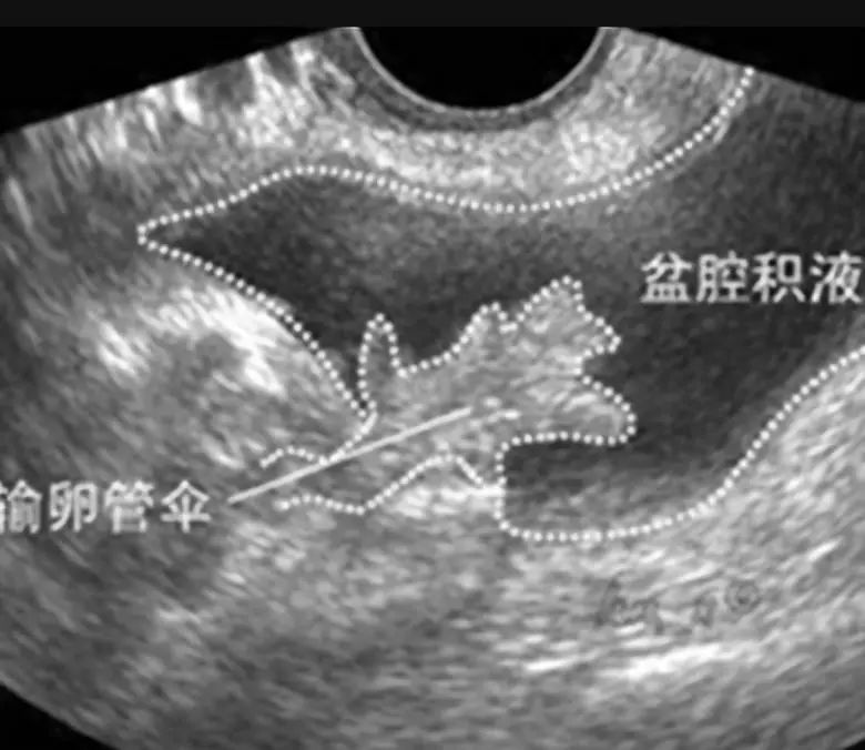 盆腔积液是什么会影响怀孕吗